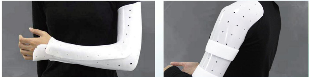 Thermoplastic splint for hand.jpg